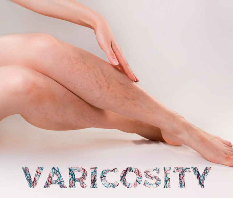 enfermedades vasculares y varices