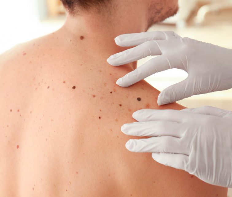 como cuidar nuestra piel del melanoma