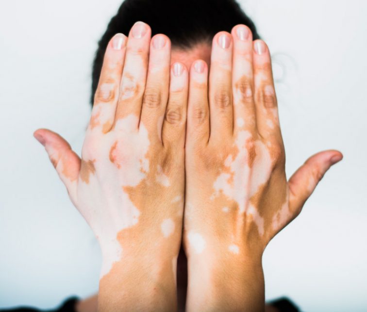 que es el vitiligo y como curarla