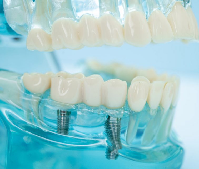 implantes dentales, beneficios de la salud